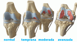 Evolucion de gonartrosis